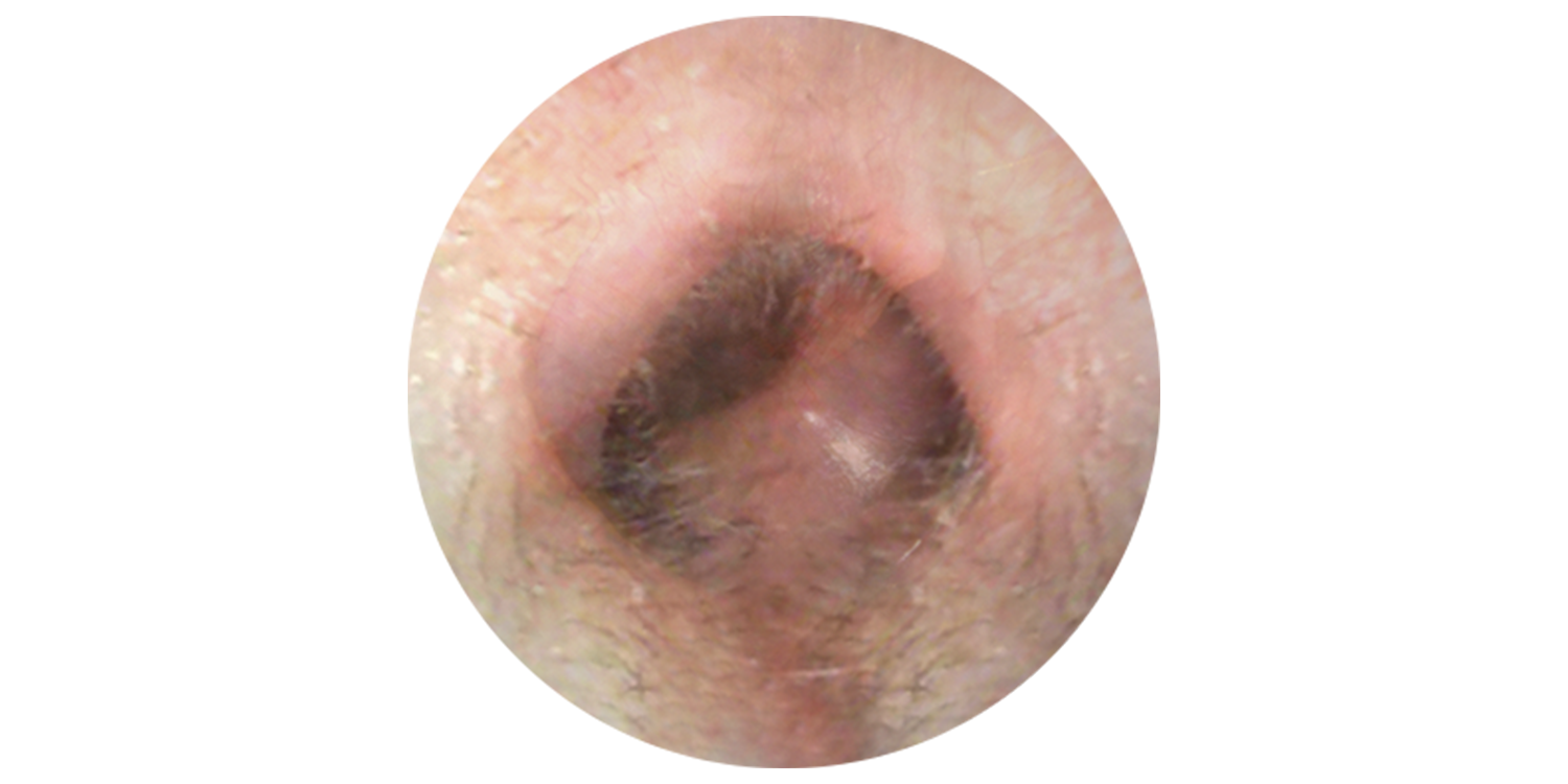 Earway ear wax after
