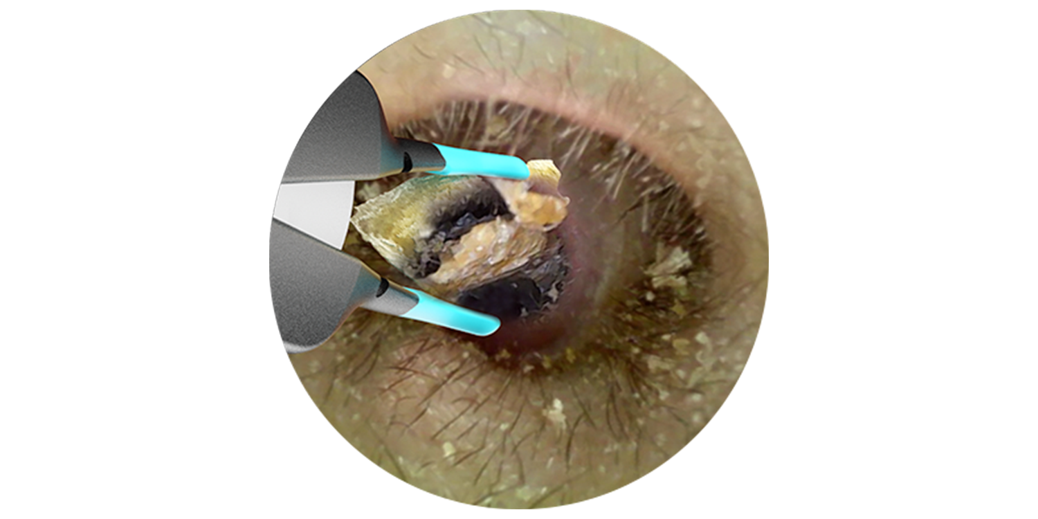 Earway ear wax before
